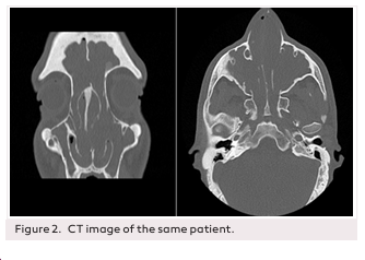 Woakes&rsquo; Syndrome; Rare Manifestation of Nasal Polyposis: Experience of Seven Patients
