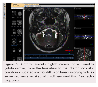 The Value of Diffusion Tensor Imaging in Evaluation of Patients with Bell&rsquo;s Palsy