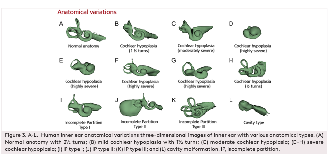 Design of a Cochlear Implant Electrode