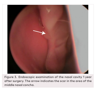Chondromesenchymal Hamartoma of the Anterior Cells of the Ethmoidal Labyrinth