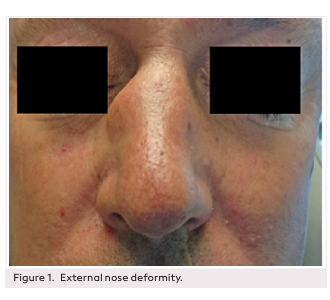 Nasal Gout: A Rare Pathology