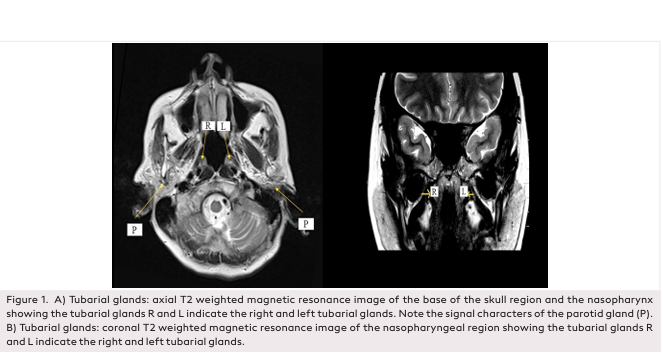 Incidence and Anatomy of Tubarial Salivary Gland in Local Indian Population