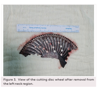 Injury with a Metal Cutting Wheel Involving Three Anatomical Regions of the Neck