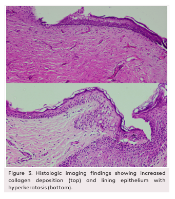Pierre Robin Syndrome and a Subglottic Mass in a Patient with Bruck Syndrome: An Unusual Presentation of an Extremely Rare Condition