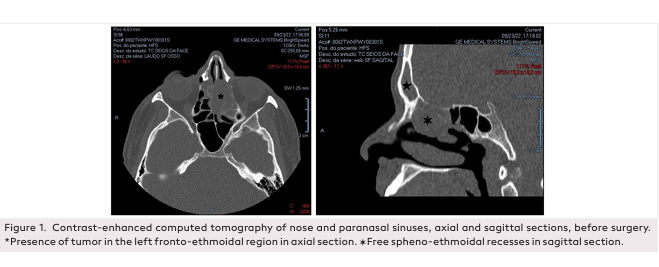 Endoscopic Resection of a Rare Case of Frontoethmoidal Glomangiopericytoma: A Case Report