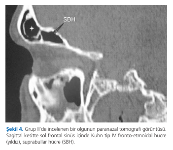 The radiological evaluation of anatomical variations of frontal recess in normal population and cases with frontal rhinosinusitis