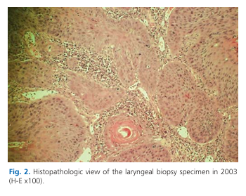 Interesting 54 months survival after platinum based induction chemotherapy regimen alone in a patient with T2N0M0 supraglottic carcinoma