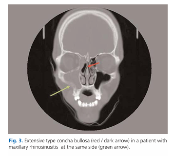 The relationship among concha bullosa, septal deviation and chronic rhinosinusitis