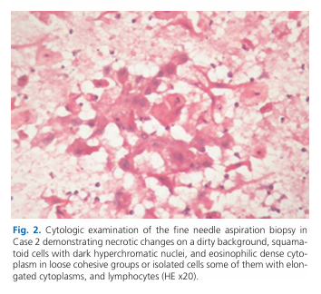 Branchial cleft cyst presenting as metastatic squamous carcinoma in fine needle aspirates: report of three case