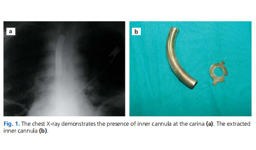 Inner cannula aspiration in a laryngectomized patient: a case report
