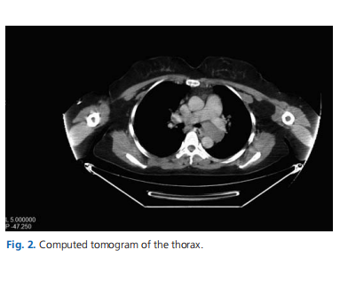 Left vocal cord paralysis due to lymphadenopathy of mediastinal tuberculosis
