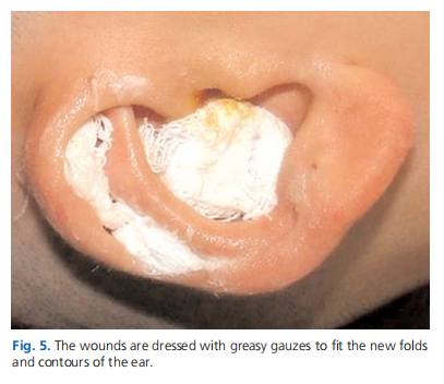 Combined Mustard&eacute; and Furnas type otoplasty: the experience of 85 patients