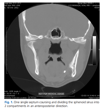 Radiological evaluation of septal bone variations in the sphenoid sinus