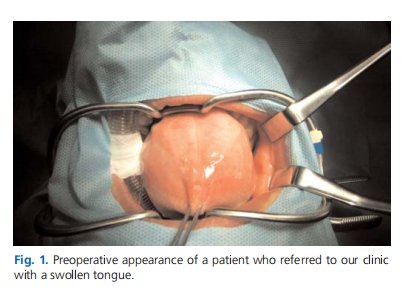 Granular cell tumor of the tongue