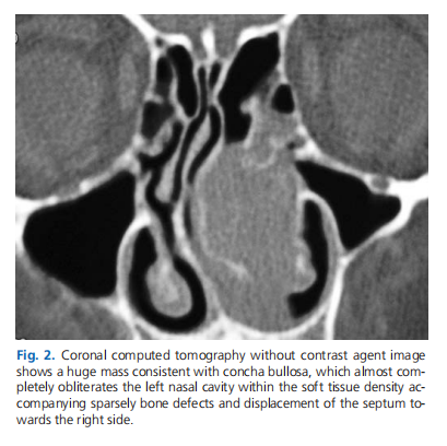 Actinomycosis in concha bullosa: a case report