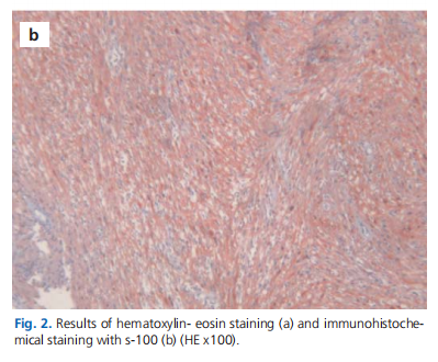 Nasal septal schwannoma