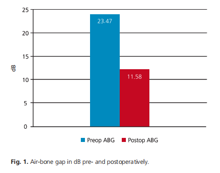 Tympanoplasty type 1 in the treatment of patients with sclerotic mastoid: anatomical and functional results