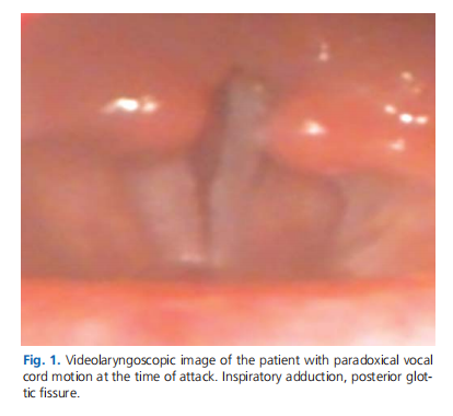 Evaluation of paradoxical vocal cord motion and differential diagnosis