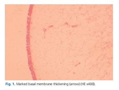 The correlation of clinical measures with the histopathological findings in nasal polyposis