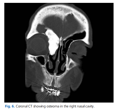 Unilateral nasal pathologies: clinical presentation and management