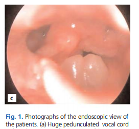 Obstructive laryngeal polyps presenting with dyspnea: report of five rare cases