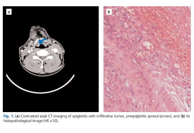 Potential pitfalls of computed tomography in advanced laryngeal cancer