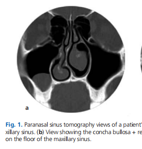 Computed tomography analysis of sinonasal anatomical variations and relationship with the maxillary sinus retention cysts