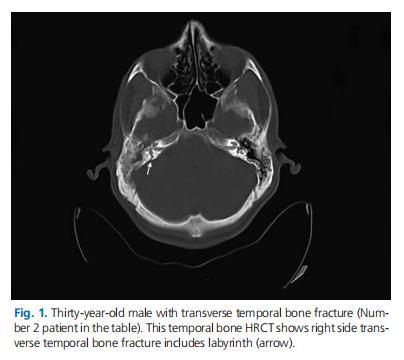 Surgical intervention for traumatic facial paralysis: an analysis of 15 patients