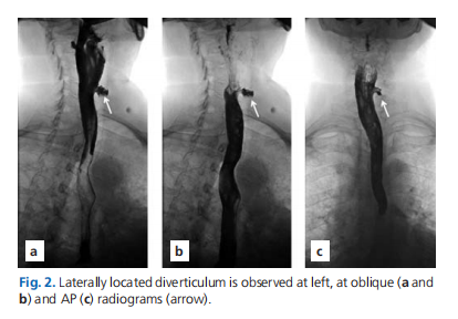 Ultrasonographic features of pharyngoesophageal diverticulum in a case misdiagnosed as a thyroid nodule: a case report and review of the literature