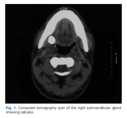 Rare coexistence of sialolithiasis and actinomycosis in the submandibular gland