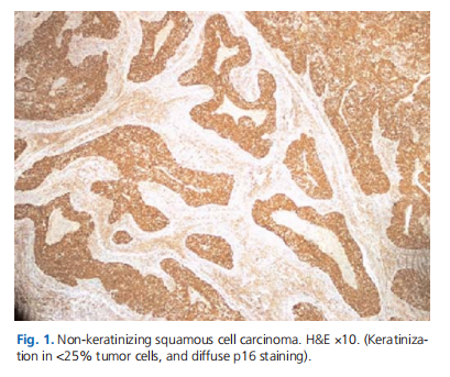 Effect of p16 positivity in oral cavity and oropharyngeal squamous cell carcinoma