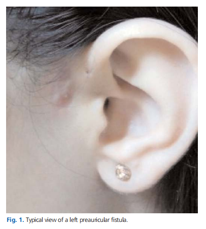 Head and neck fistulas of congenital or infectious etiology: retrospective analysis of 23 cases