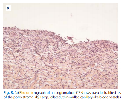 Giant angiomatous choanal polyp originating from the middle turbinate: a case report