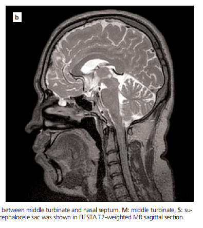 Ethmoidal meningoencephalocele and cerebrospinal fluid leak after septoplasty: a rare complication