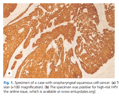 Detection of human papilloma virus in normal and tumoral oropharyngeal tissue using HPV DNA in situ hybridization and p16 expression and its clinicopathologic importance