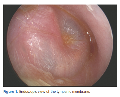 Oto-endoscopic Versus Microscopic Ventilation Tube Placement In Children