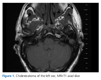 Diagnostic Performance of Diffusion-Weighted Magnetic Resonance Imaging in Patients with Cholesteatoma