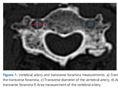 Anatomical Considerations: The Relationship Between The Vertebral Artery And Transverse Foramina At Cervical Vertebrae 1 To 6 In Patients With Vertigo