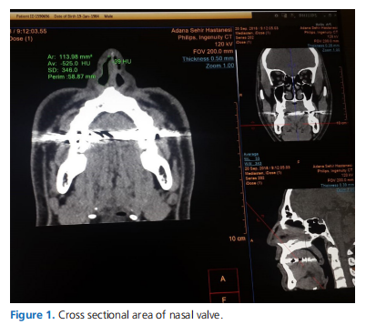Morphological Analysis Of Obstructive Sleep Apnoea Patients Using Computed Tomography