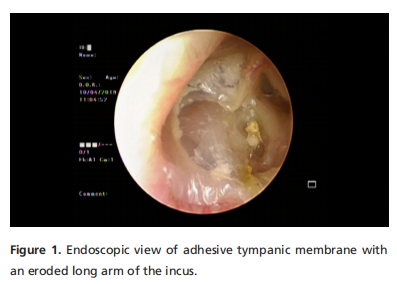 How do you perform your tympanoplasty, endoscopically or microscopically?