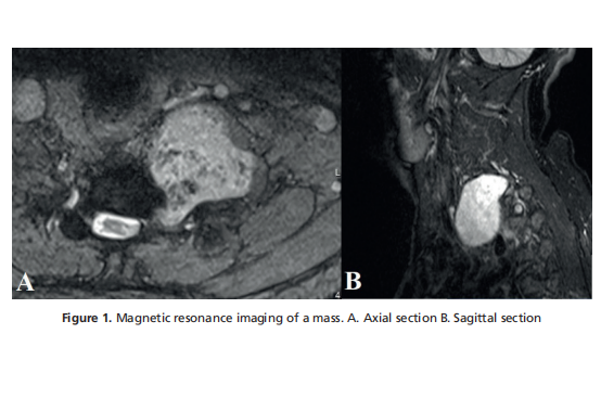 Head and Neck Schwannomas: A Tertiary Referral Single-Centre Experience