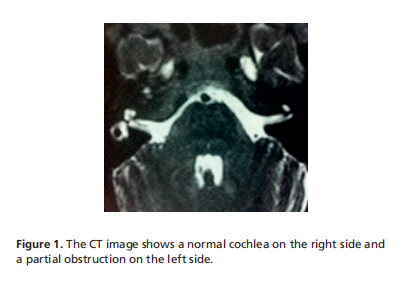 Successful partial cochlear implantation in a patient with relapsing polychondritis