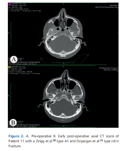 Closed reduction of zygomatic arch fractures using a Tubbs-Logan mitral valve dilator