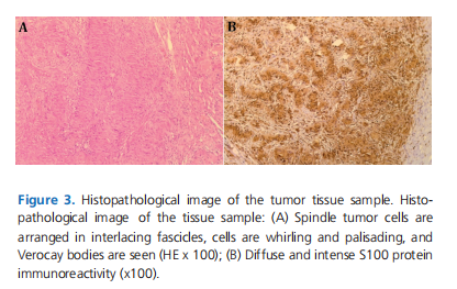 Hypopharyngeal schwannoma: A case report of a rare entity