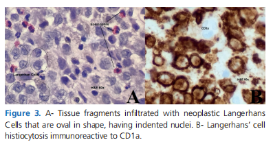 A great mimicker of mastoiditis: Multisystem Langerhans&rsquo; cell histiocytosis
