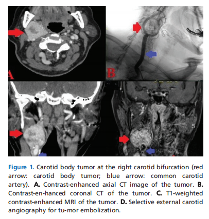 Carotid body tumors: what have we learned in 5 years?