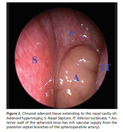 Complications of transoral endonasal-controlled combined endoscopic adenoidectomy