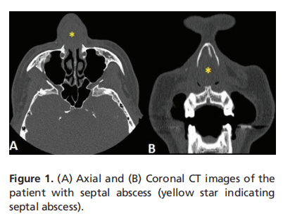 Analysis of patients with septal abscess caused by electrocauterization of the nasal septum