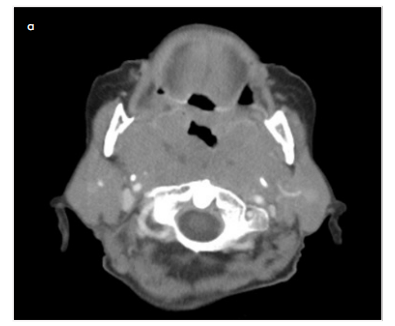 Can imaging features be used to predict prognosis in extranodal head and neck lymphomas?