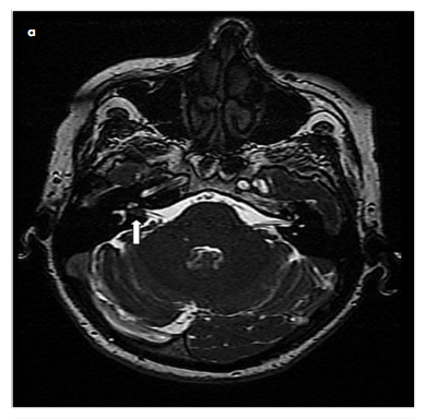 Cost Analysis of Contrast Enhancement in Magnetic Resonance Imaging for Screening Retrocochlear Pathologies in Asymmetric Hearing Loss